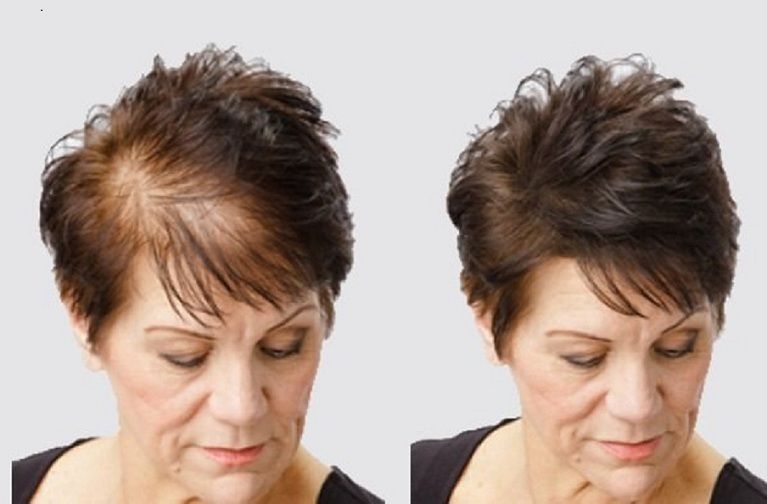 caboki hair loss treatment dark brown