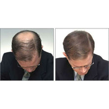 caboki hair loss treatment dark brown